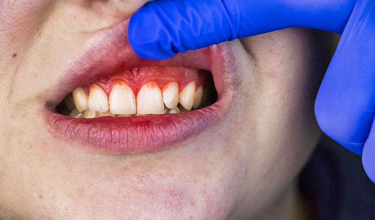 periodontitis symptoms