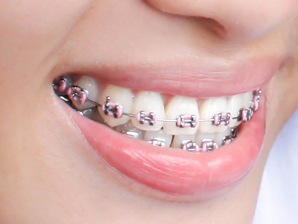 pink braces