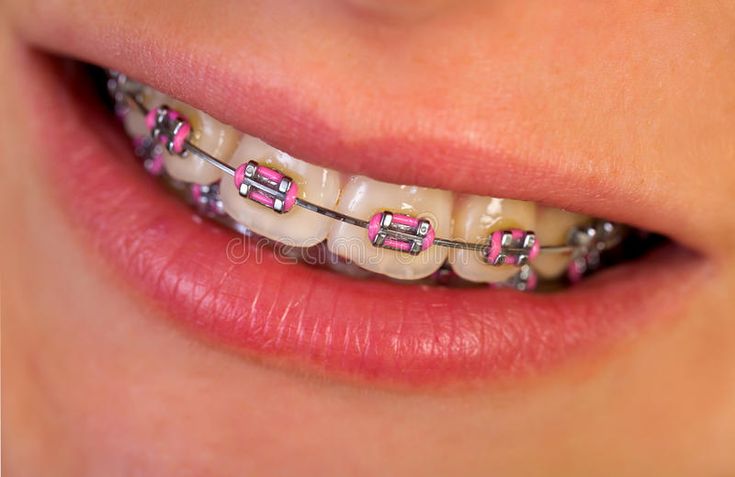 hot pink braces