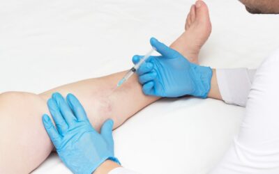 are varicose vein treatments covered by insurance